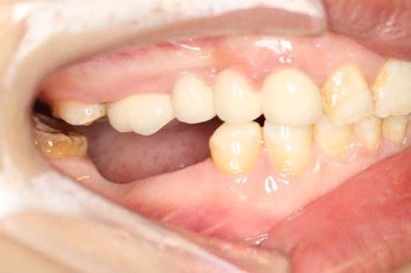 牙齿缺失为什么要镶