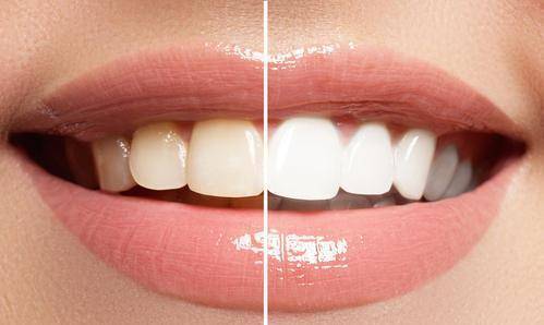 着色和变色牙齿能美白吗