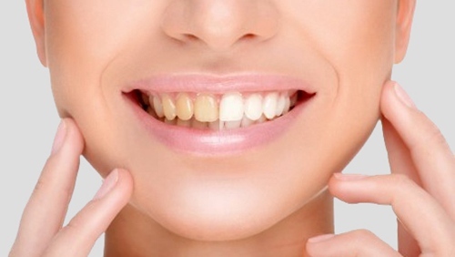 什么是家庭使用的牙齿漂白方法