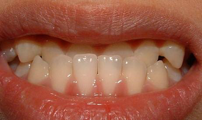 如何预防“地包天”