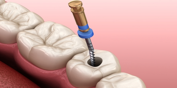 根管治疗是什么