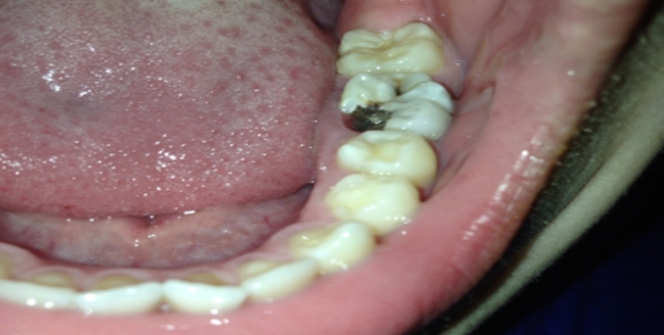 填补后的牙齿要注意些什么