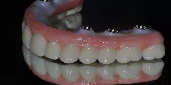 什么是覆盖假牙、即刻假牙、桩冠