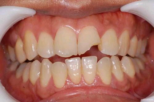 意外的牙齿外伤后应该怎么办