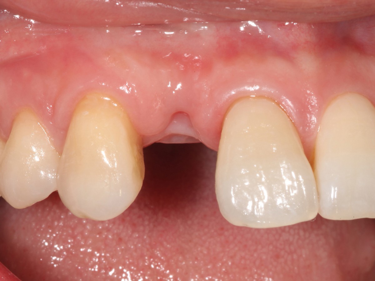 什么是牙体缺损 牙体缺损修复前要做什么准备