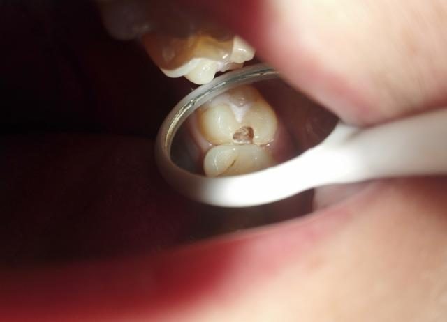 修复后食物嵌塞是怎么出现的