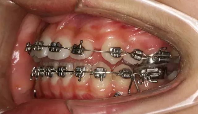 支抗种植体的稳定性是什么