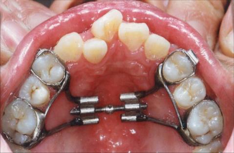 牙弓可以扩展吗