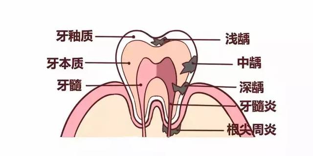 牙髓病的病因有哪些