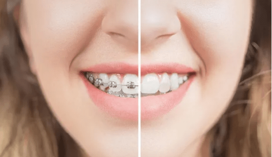 外科正牙术是什么
