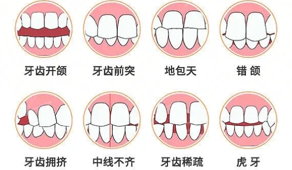 儿童期错颌畸形的早期预防