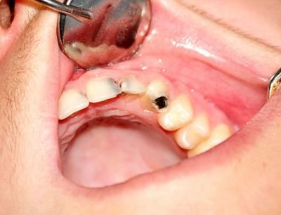 龋齿都有哪些症状