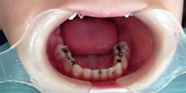 龋齿有什么危害