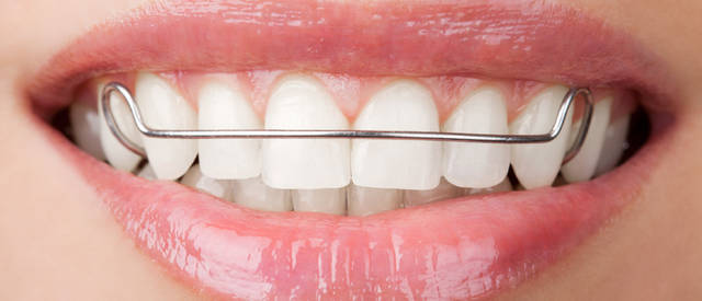 为什么治疗结束后要戴保持器