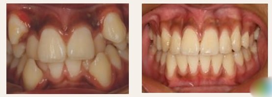 牙列不齐的表现是什么