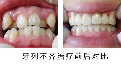 什么情况的牙列不齐暂时不需矫正