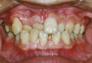 牙列不齐有什么危害性