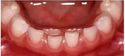 哪些常见的口腔发育障碍和缺陷会引起牙列不齐