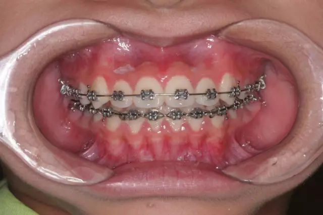 正畸治疗过程中有什么反应