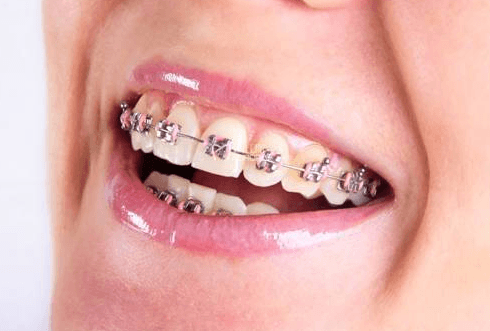 成人牙列不齐的矫正与儿童有什么区别