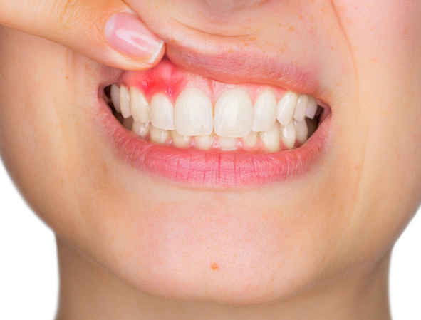 牙龈为什么会出血