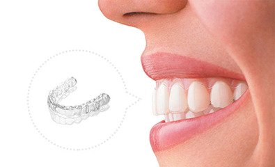 活动矫治器的应用范围及局限性