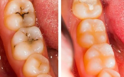 龋病的好发部位是什么