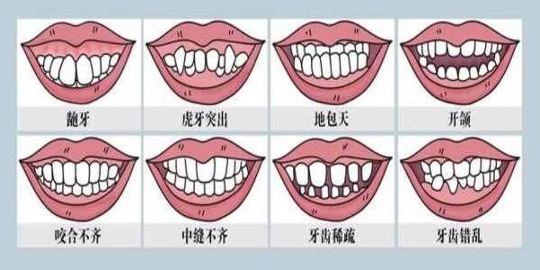 遗传因素引起的错颌牙是什么