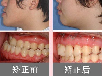  矫治前牙反颌过程中特殊情况的处理