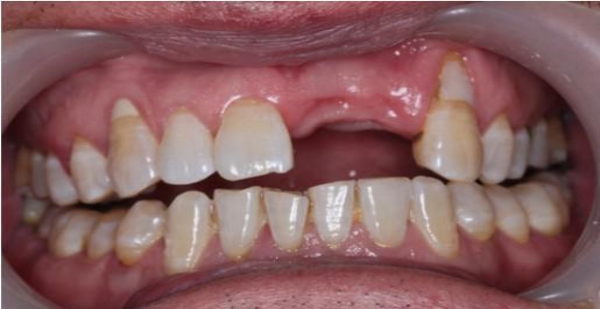 牙体缺损的病因及影响