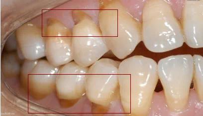 洗牙会对牙齿造成损伤吗