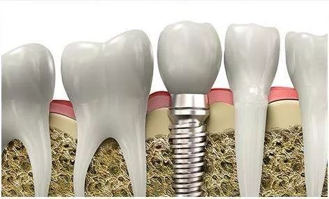 什么样的患者不适合种植义齿