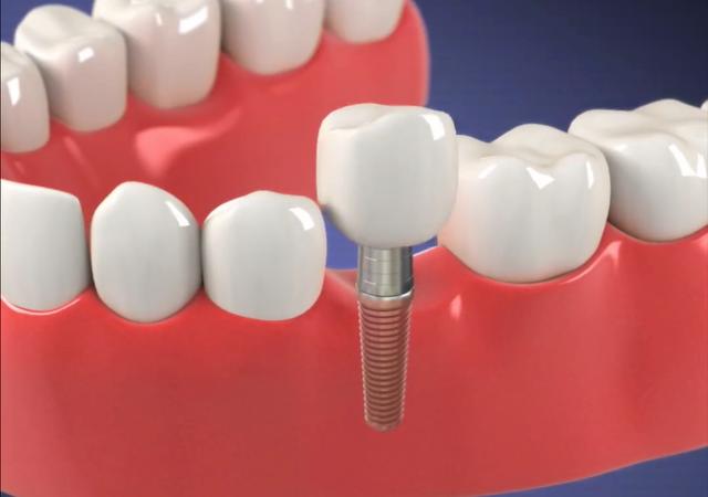 牙种植体材料应用具备的条件与性能