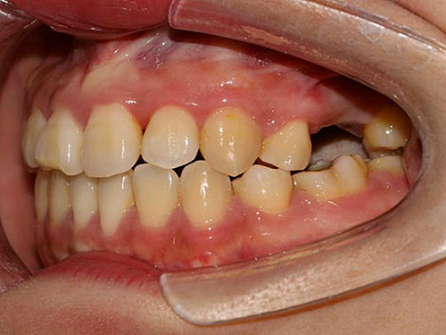 牙列缺损的临床表现有哪些