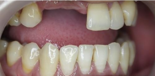 牙列缺损修复前需做什么准备