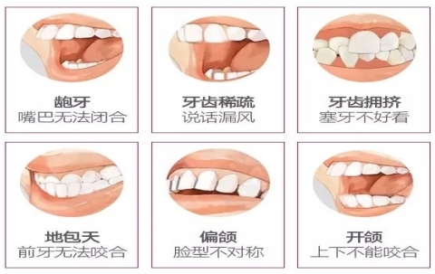 牙齿错颌畸形的危害是什么