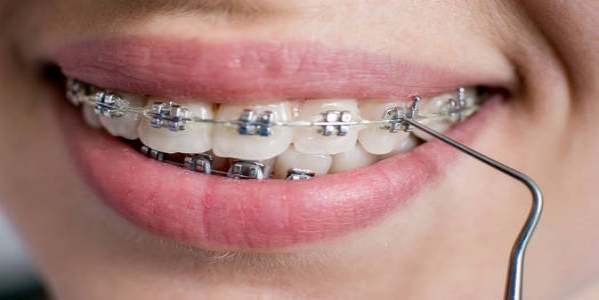 牙齿正畸的矫治机理是什么