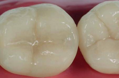 窝沟封闭的适应症是什么 窝沟封闭的操作过程是什么