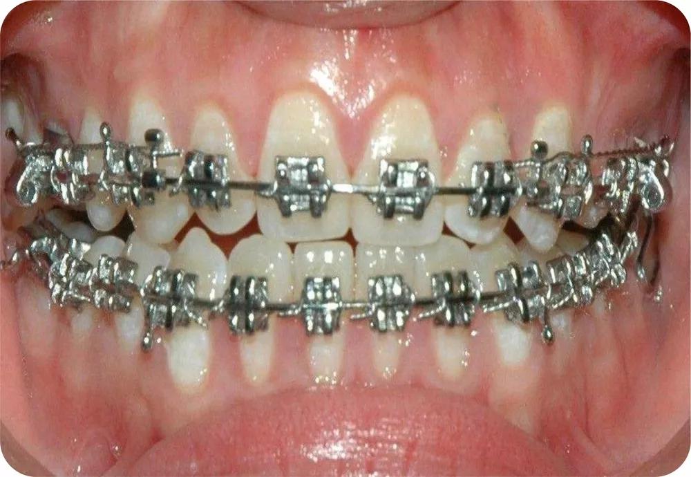 正畸中牙齿移动的种类有什么