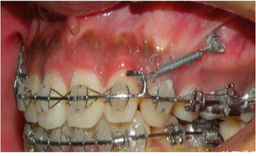 支抗在正畸治疗中的意义是什么