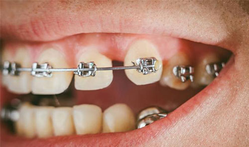 间隙在正畸治疗中的意义是什么