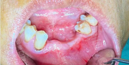 可摘局部义齿的作用