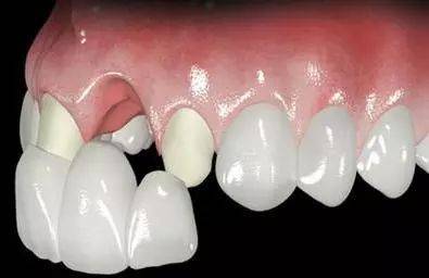 固定义齿戴用后可能出现的问题和处理