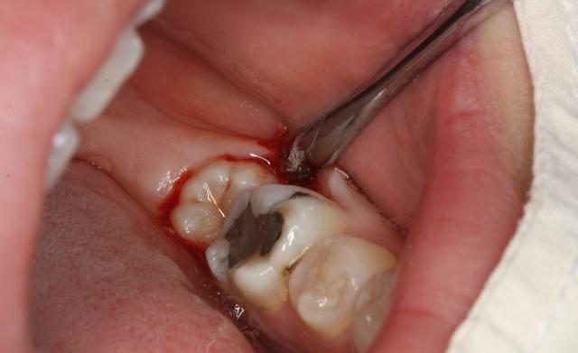 龋病的病变类型有哪些