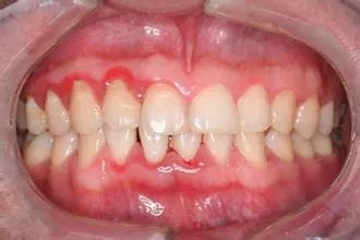 牙周疾病的治疗方法
