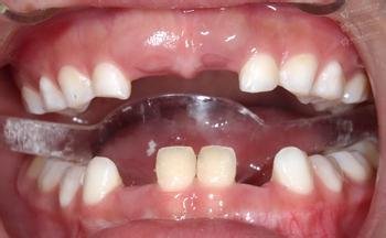 牙齿缺损和畸形对健康有什么影响