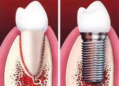拔牙后行人工牙种植的适宜时期