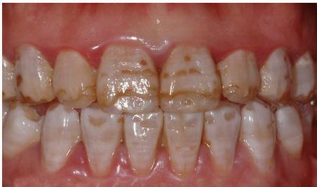 牙齿变色的临床表现是什么