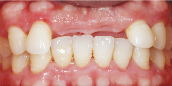 牙周炎治疗的目标是什么