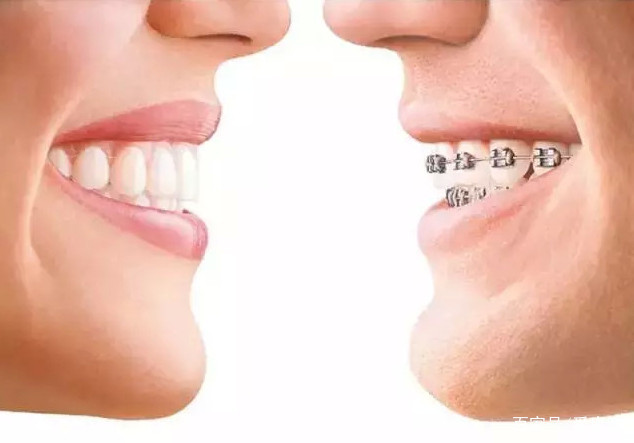 牙齿矫正的3个误区